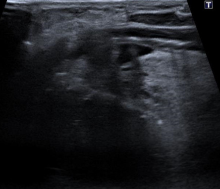 Guidage échographique pour radiofréquence thyroïdienne — Radiologie Interventionnelle Cochin