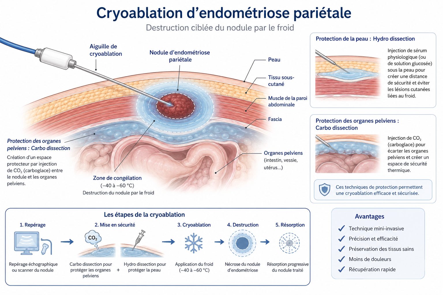 Schéma de la cryoablation d'endométriose pariétale : aiguille de cryoablation, zone de congélation, protection de la peau par hydro-dissection et protection des organes pelviens par carbo-dissection