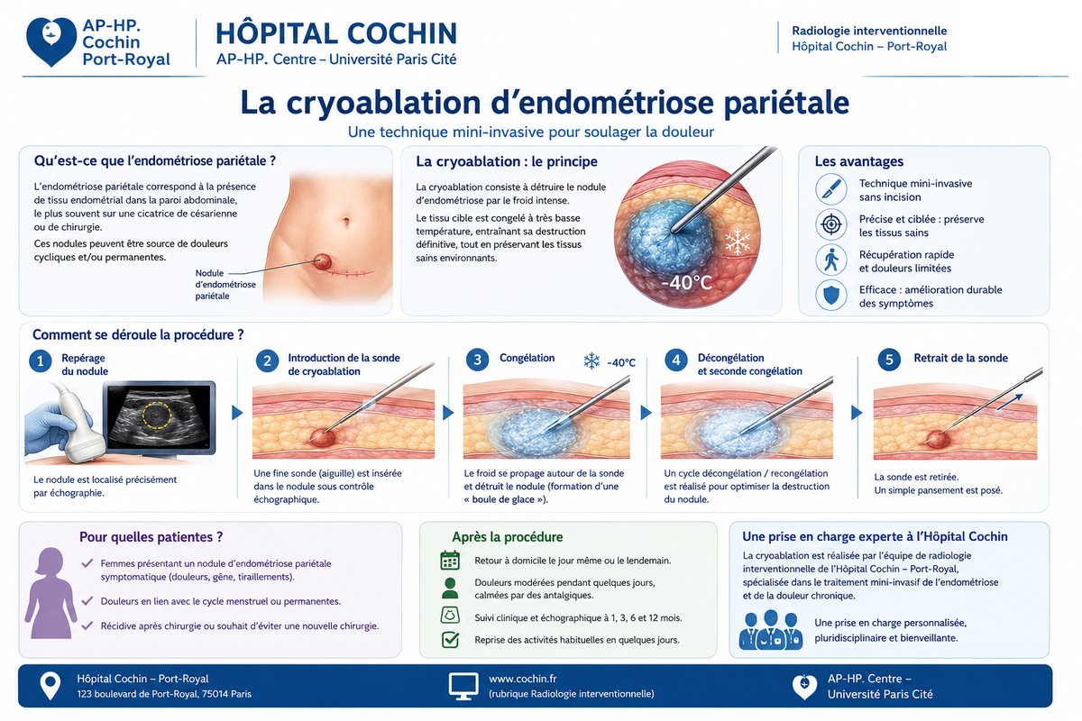Schéma explicatif de la cryoablation de l'endométriose pariétale — Hôpital Cochin AP-HP