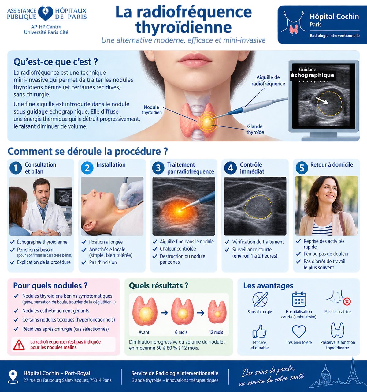 Schéma explicatif de la radiofréquence thyroïdienne — Hôpital Cochin AP-HP