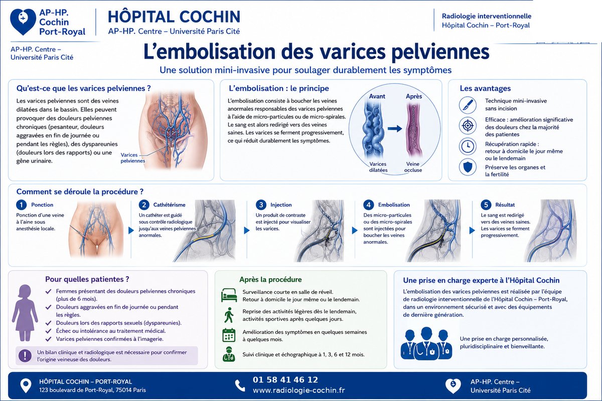 Schéma explicatif de l'embolisation des varices pelviennes — Hôpital Cochin AP-HP